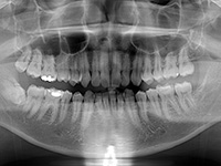 歯並びの治療について