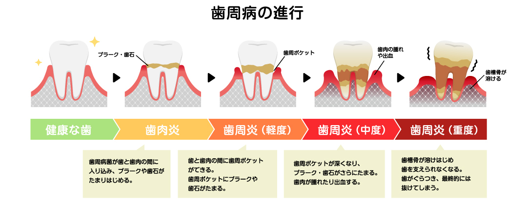 歯周病の進行の図